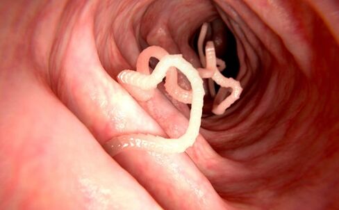 İnsan vücudundaki solucanlar