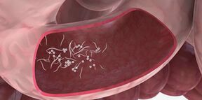 Parazitleri çıkarmak için üçüz kullanımı