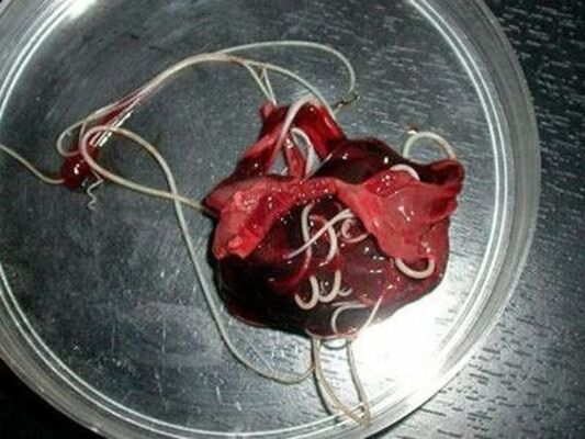 insan vücudundaki solucanlar